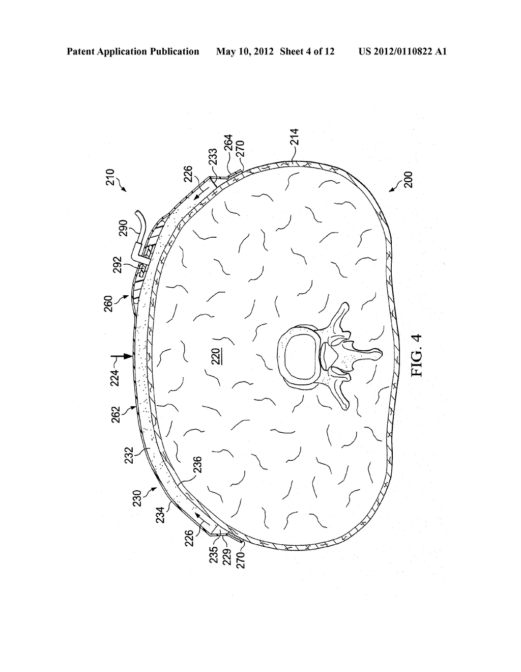 REDUCED-PRESSURE, COMPRESSION SYSTEMS AND APPARATUSES FOR USE ON BREAST     TISSUE - diagram, schematic, and image 05