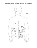 REDUCED-PRESSURE, COMPRESSION SYSTEMS AND APPARATUSES FOR USE ON BREAST     TISSUE diagram and image