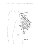 REDUCED-PRESSURE, COMPRESSION SYSTEMS AND APPARATUSES FOR USE ON BREAST     TISSUE diagram and image
