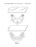 CUSTOM MOUTHGUARD diagram and image