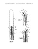 Surgical Stapling Device diagram and image