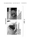 TREATMENT OF CHRONIC ULCEROUS SKIN LESIONS diagram and image