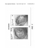 TREATMENT OF CHRONIC ULCEROUS SKIN LESIONS diagram and image