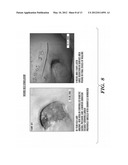 TREATMENT OF CHRONIC ULCEROUS SKIN LESIONS diagram and image