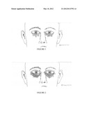 Method For The Treatment Of Infraorbital Dark Circles Using Botulinum     Toxins diagram and image