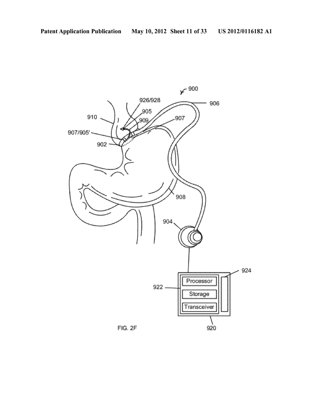 Feedback Systems and Methods to Enhance Obstructive and Other Obesity     Treatments, Optionally Using Multiple Sensors - diagram, schematic, and image 12