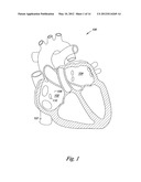 OCCLUSION APPARATUS diagram and image