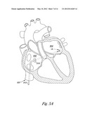 OCCLUSION APPARATUS diagram and image