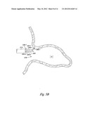 OCCLUSION APPARATUS diagram and image