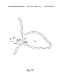 OCCLUSION APPARATUS diagram and image