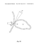 OCCLUSION APPARATUS diagram and image