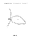 OCCLUSION APPARATUS diagram and image