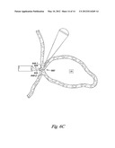 OCCLUSION APPARATUS diagram and image