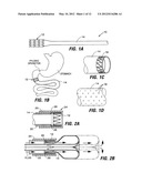 INTESTINAL SLEEVES AND ASSOCIATED DEPLOYMENT SYSTEMS AND METHODS diagram and image