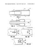 INTESTINAL SLEEVES AND ASSOCIATED DEPLOYMENT SYSTEMS AND METHODS diagram and image