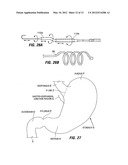 INTESTINAL SLEEVES AND ASSOCIATED DEPLOYMENT SYSTEMS AND METHODS diagram and image