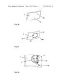 METHOD FOR IMPLANTING AN ACCESS PORT diagram and image