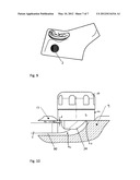 METHOD FOR IMPLANTING AN ACCESS PORT diagram and image