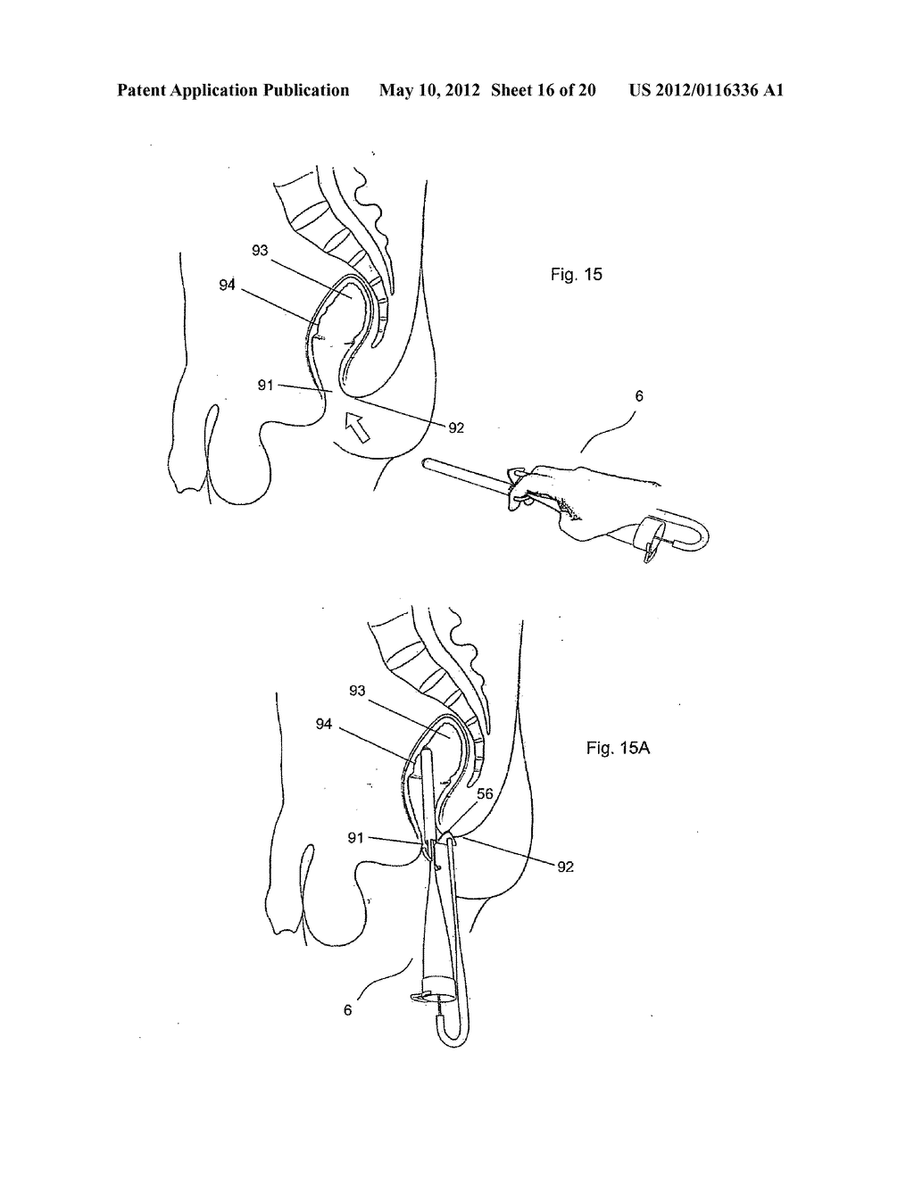 Device For Collecting Fecal Discharge In Incontinent Patients - diagram, schematic, and image 17