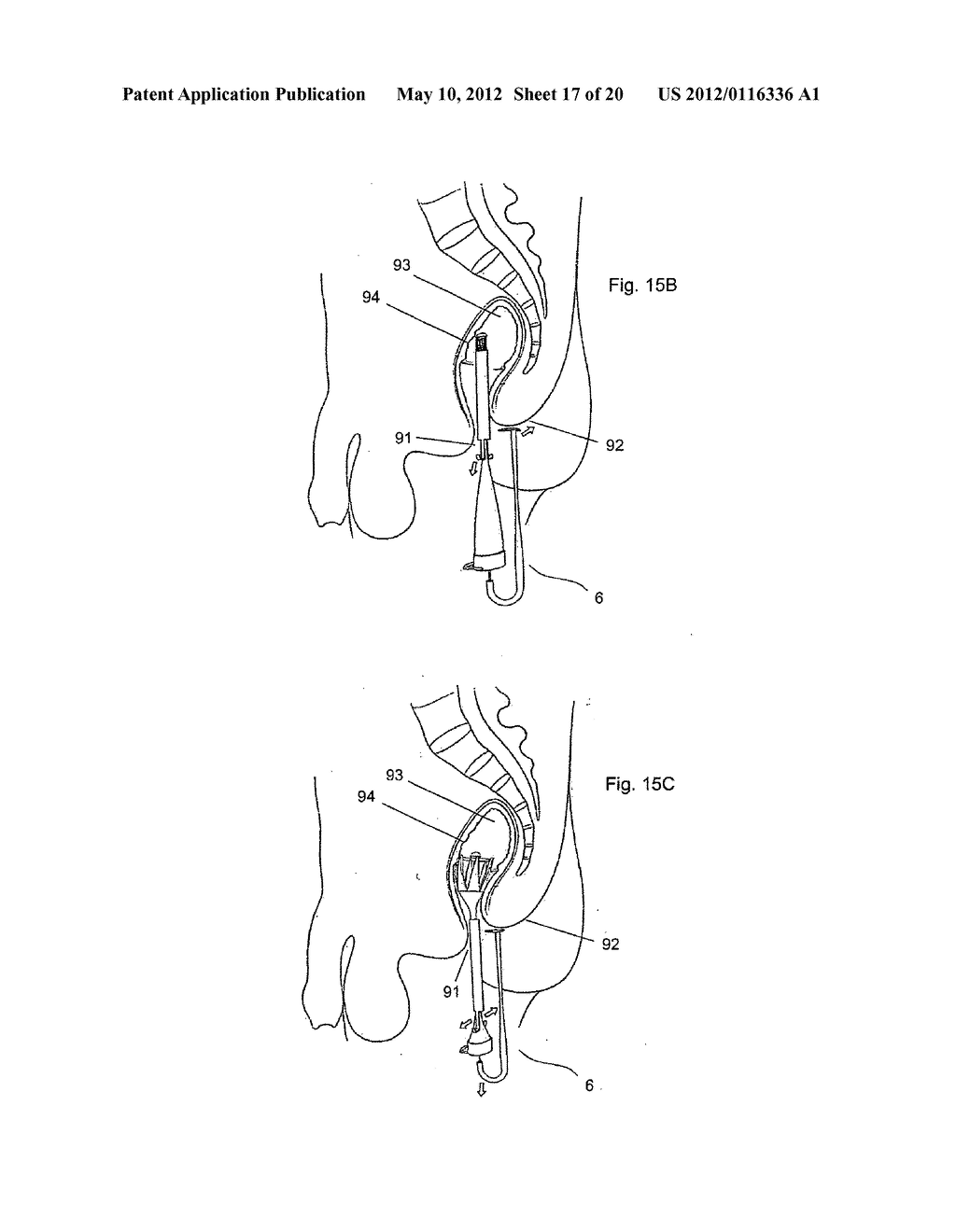 Device For Collecting Fecal Discharge In Incontinent Patients - diagram, schematic, and image 18