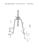 SINGLE PORT LAPAROSCOPIC ACCESS WITH LATERALLY SPACED VIRTUAL INSERTION     POINTS diagram and image