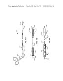 SINGLE PORT LAPAROSCOPIC ACCESS WITH LATERALLY SPACED VIRTUAL INSERTION     POINTS diagram and image