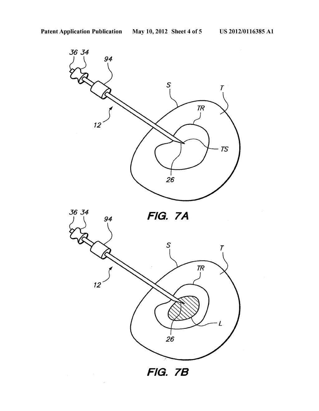 ABLATION PROBE WITH ECHOGENIC INSULATIVE SHEATH - diagram, schematic, and image 05