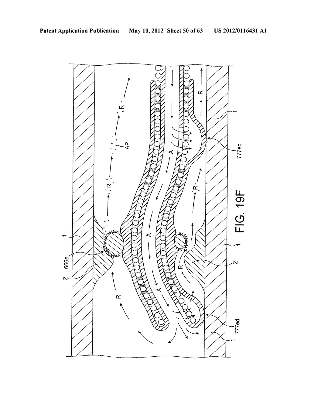 Rotational Atherectomy Device with Distal Protection Capability and Method     of Use - diagram, schematic, and image 51