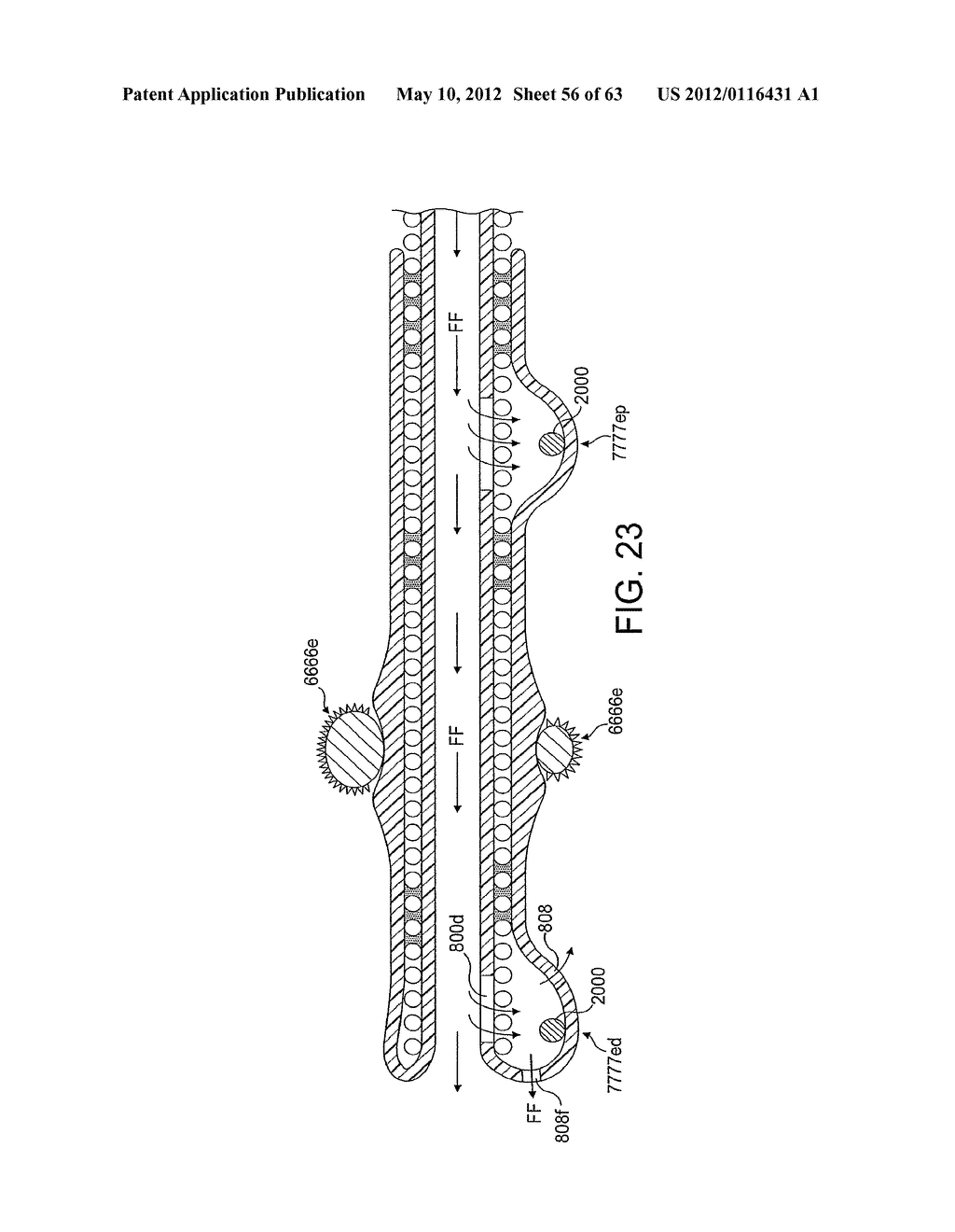 Rotational Atherectomy Device with Distal Protection Capability and Method     of Use - diagram, schematic, and image 57