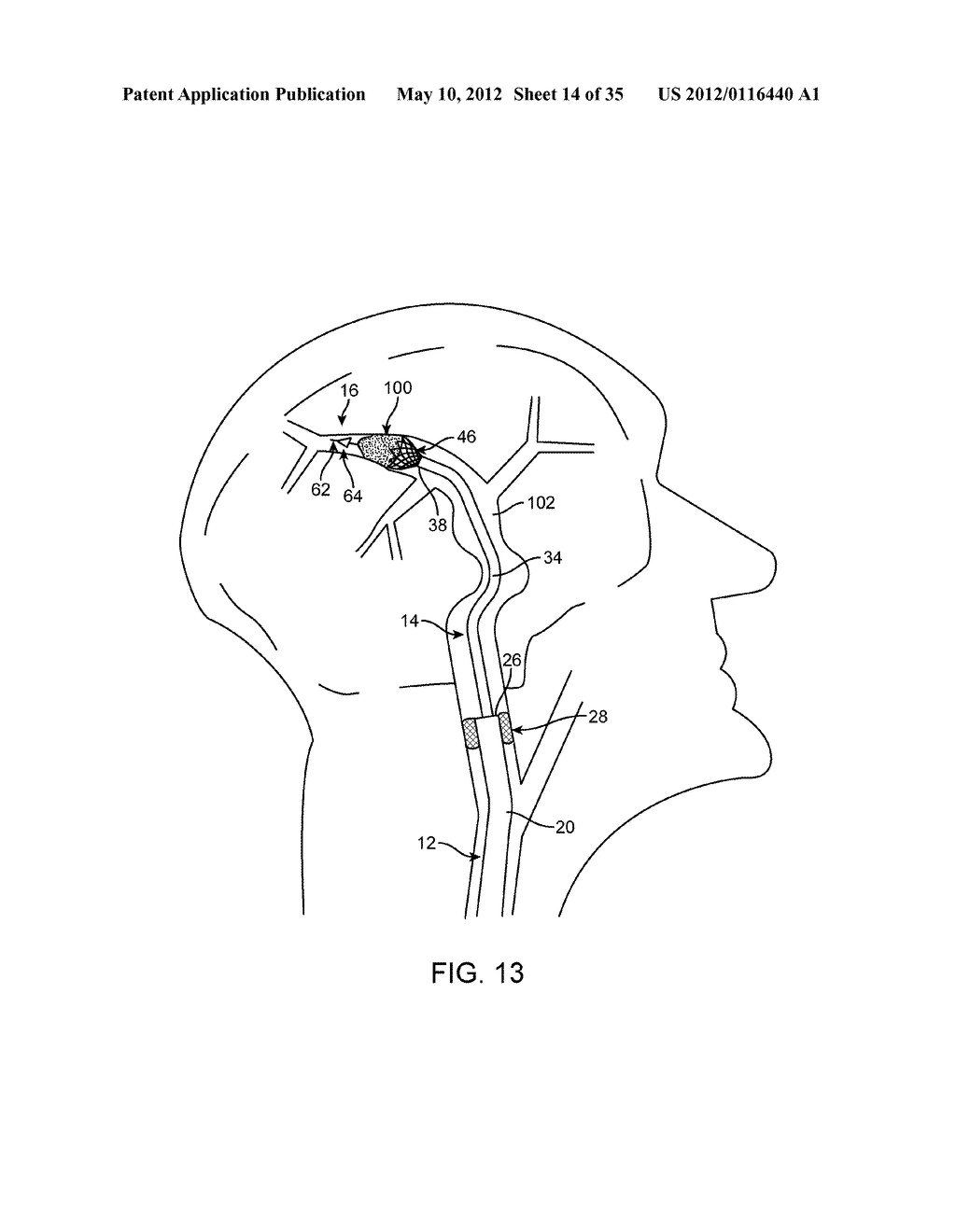 SYSTEM AND METHOD FOR TREATING ISCHEMIC STROKE - diagram, schematic, and image 15