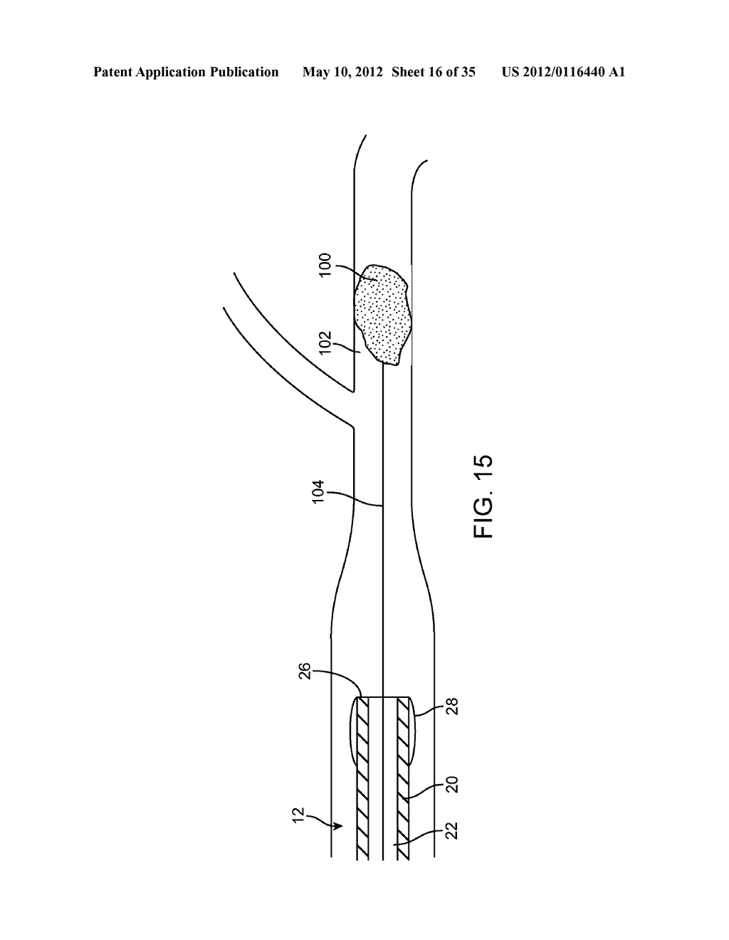 SYSTEM AND METHOD FOR TREATING ISCHEMIC STROKE - diagram, schematic, and image 17