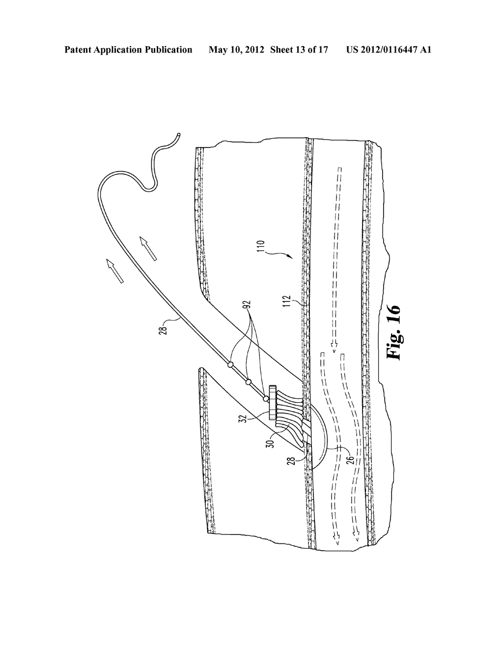 DEVICES AND METHODS USEFUL FOR SEALING BODILY OPENINGS - diagram, schematic, and image 14