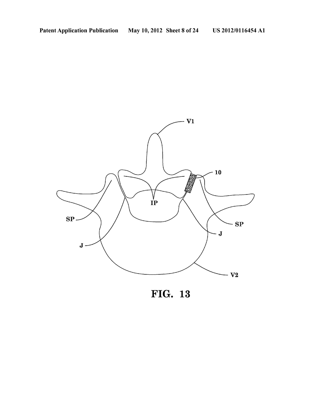 SYSTEMS AND METHODS FOR FACET JOINT STABILIZATION - diagram, schematic, and image 09