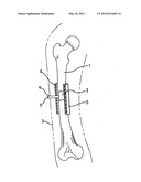 BONE REGENERATION DEVICE FOR BONES, AND METHOD OF USE diagram and image