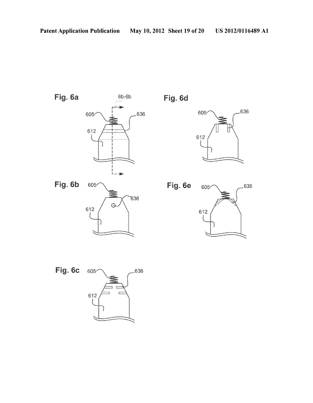 Leadless Cardiac Pacemaker with Anti-Unscrewing Feature - diagram, schematic, and image 20