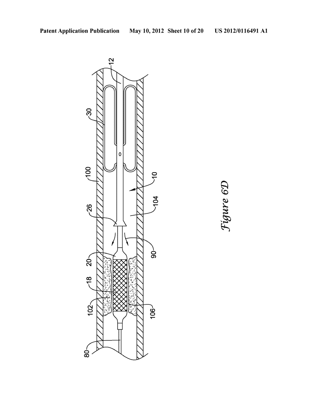 OCCLUSION CROSSING DEVICE AND METHOD - diagram, schematic, and image 11