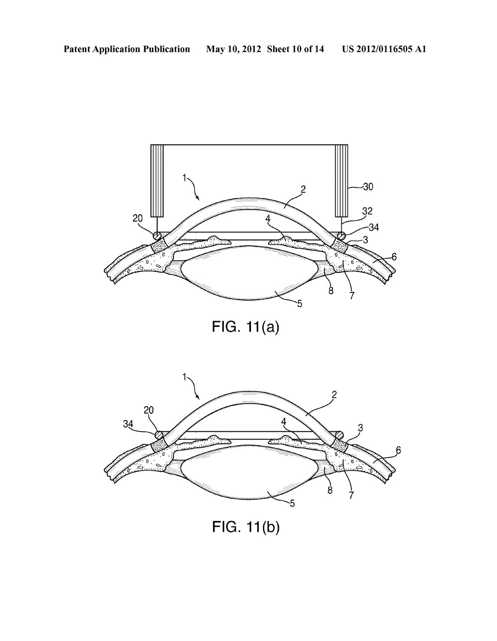 SYSTEM AND DEVICE FOR CORRECTING HYPEROPIA, MYOPIA AND PRESBYOPIA - diagram, schematic, and image 11