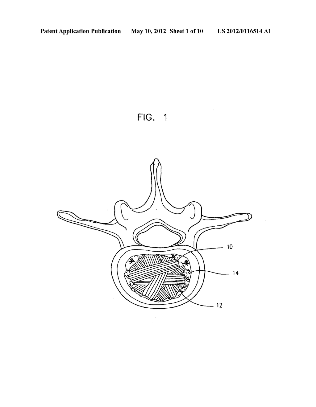 SEMI-BIOLOGICAL INTERVERTEBRAL DISC REPLACEMENT SYSTEM - diagram, schematic, and image 02