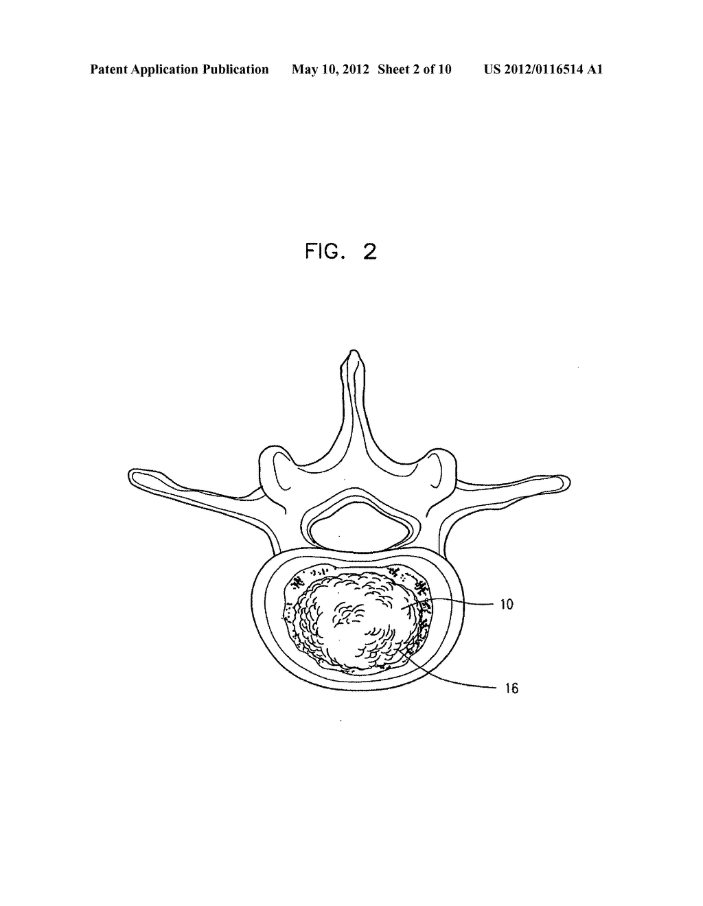 SEMI-BIOLOGICAL INTERVERTEBRAL DISC REPLACEMENT SYSTEM - diagram, schematic, and image 03