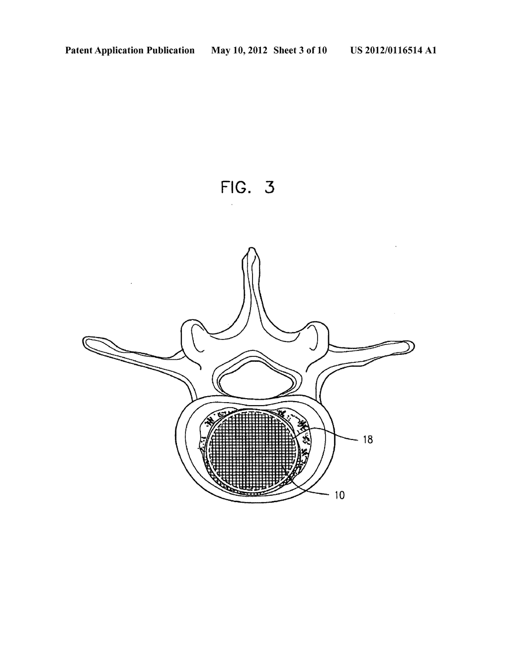 SEMI-BIOLOGICAL INTERVERTEBRAL DISC REPLACEMENT SYSTEM - diagram, schematic, and image 04