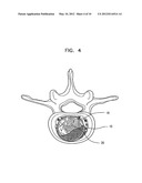 SEMI-BIOLOGICAL INTERVERTEBRAL DISC REPLACEMENT SYSTEM diagram and image