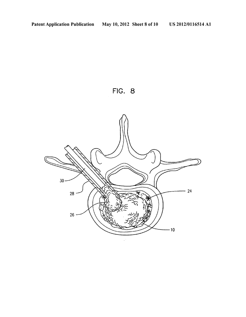 SEMI-BIOLOGICAL INTERVERTEBRAL DISC REPLACEMENT SYSTEM - diagram, schematic, and image 09