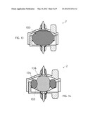 ARTIFICIAL DISC PROSTHESIS FOR REPLACING A DAMAGED NUCLEUS diagram and image