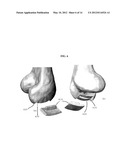 EARLY INTERVENTION KNEE IMPLANT DEVICE AND METHODS diagram and image