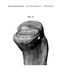 EARLY INTERVENTION KNEE IMPLANT DEVICE AND METHODS diagram and image