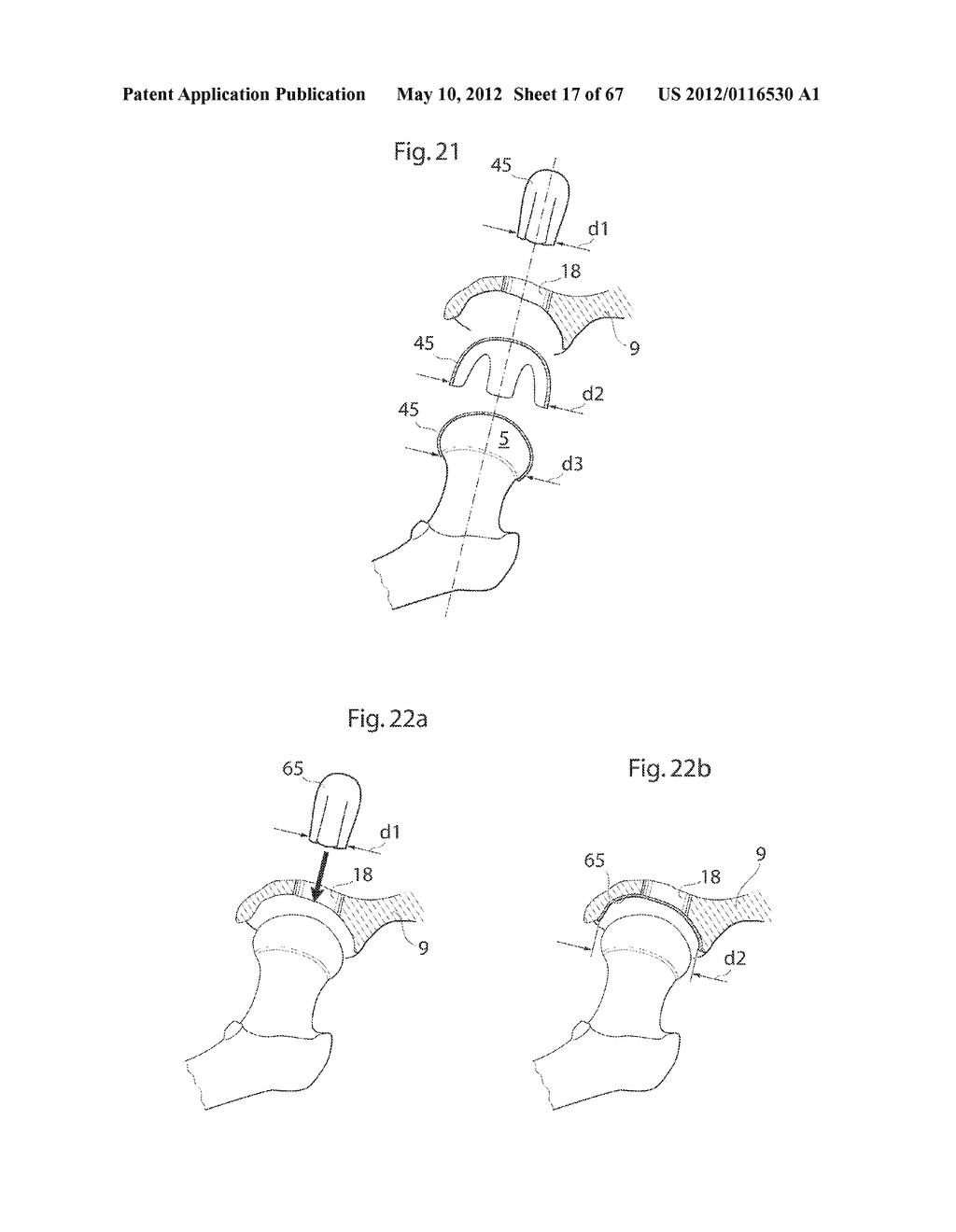 HIP JOINT DEVICE AND METHOD - diagram, schematic, and image 18