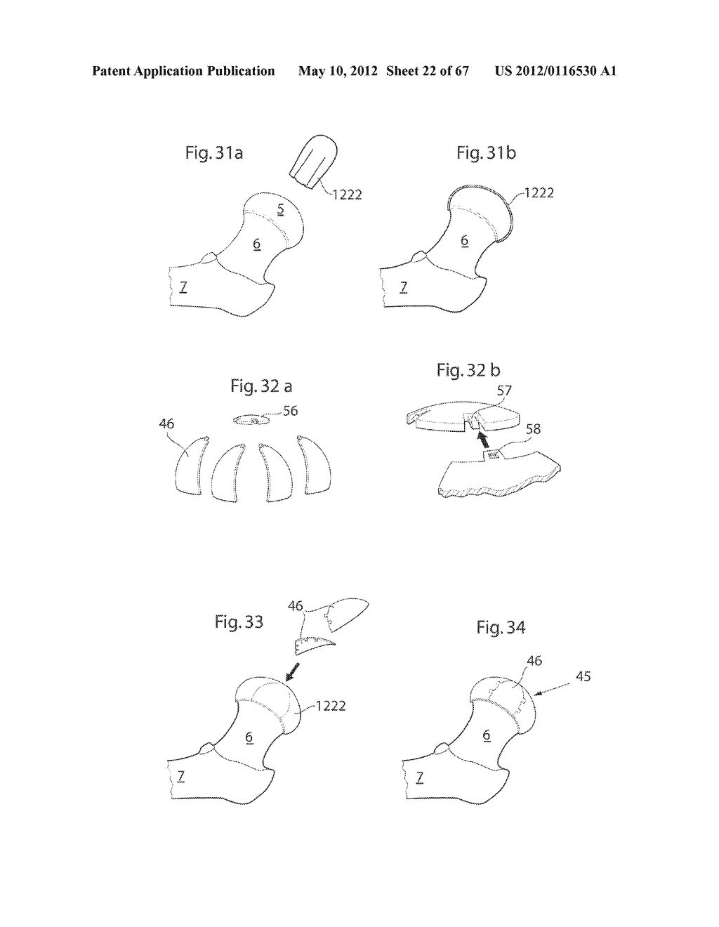 HIP JOINT DEVICE AND METHOD - diagram, schematic, and image 23