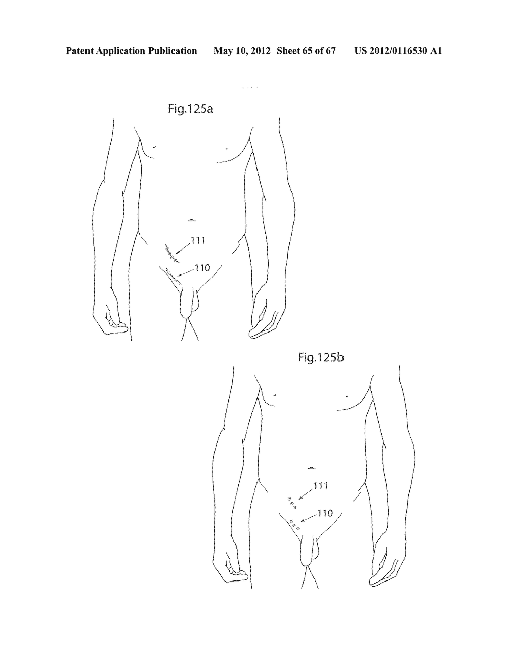 HIP JOINT DEVICE AND METHOD - diagram, schematic, and image 66