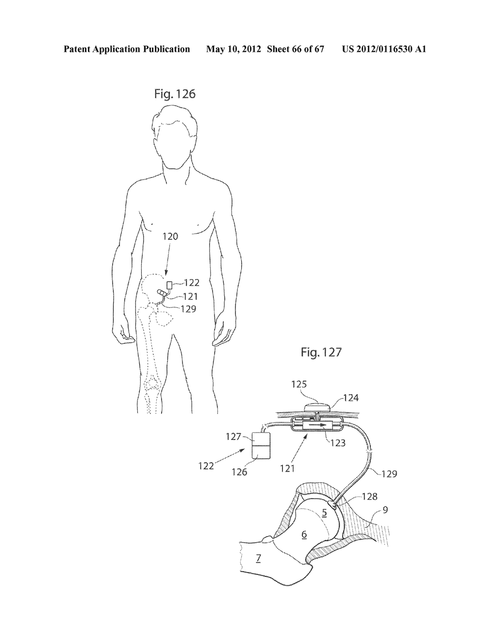 HIP JOINT DEVICE AND METHOD - diagram, schematic, and image 67