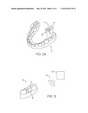 STUTTERING TREATMENT METHODS AND APPARATUS diagram and image